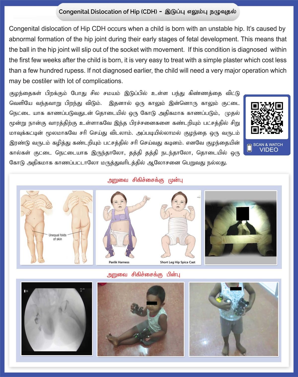 Congenital Dislocation of Hip